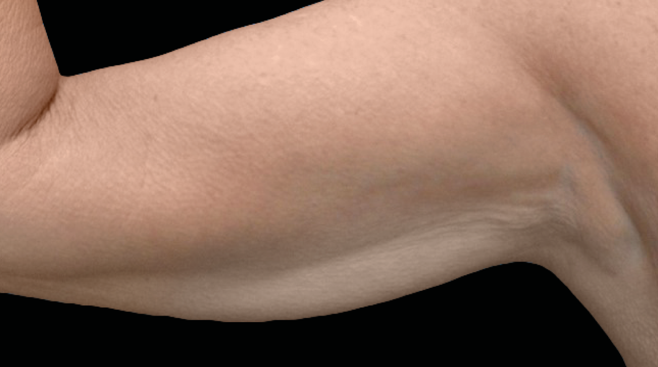 Radiofréquence Exion - Résultat bras après traitement