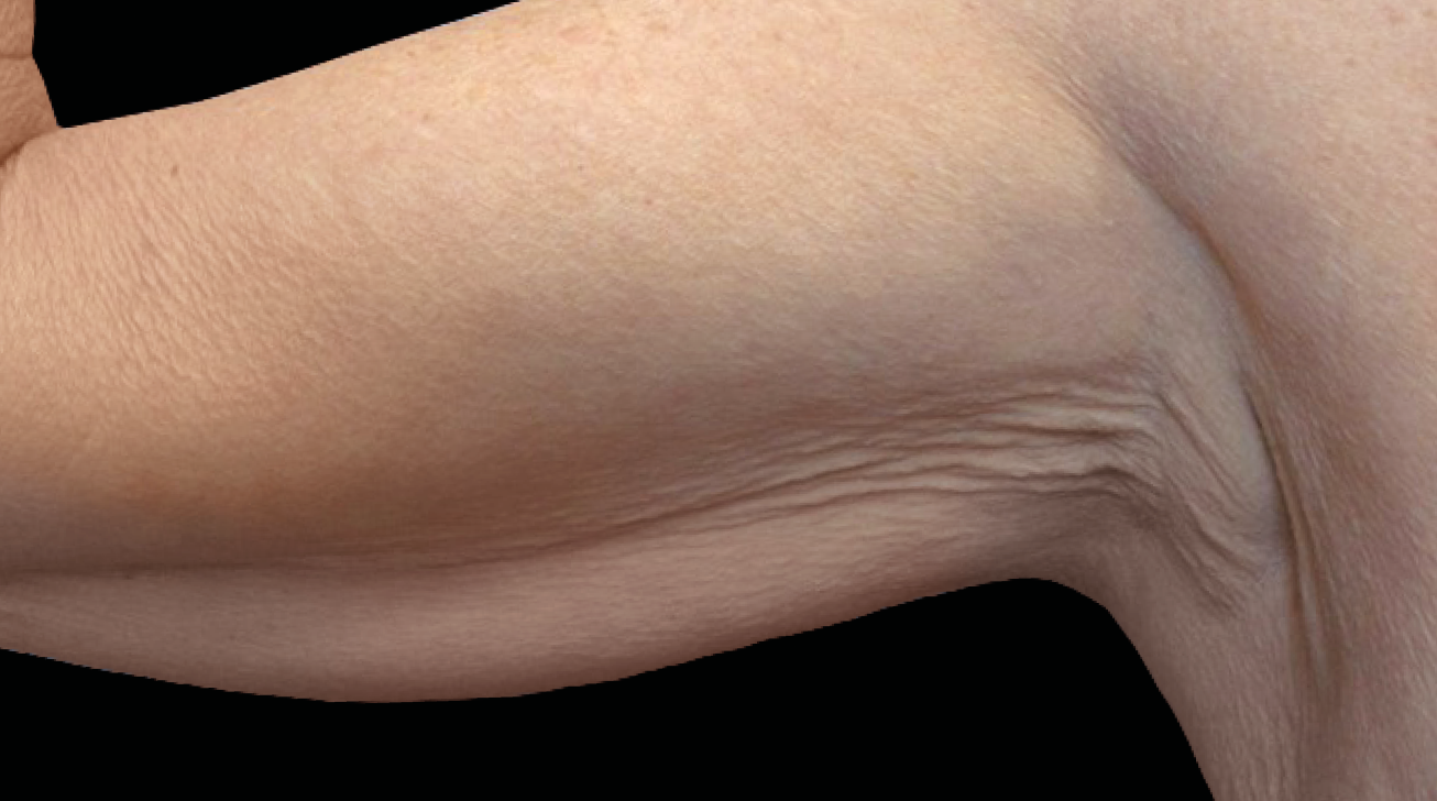 Radiofréquence Exion - Résultat bras avant traitement