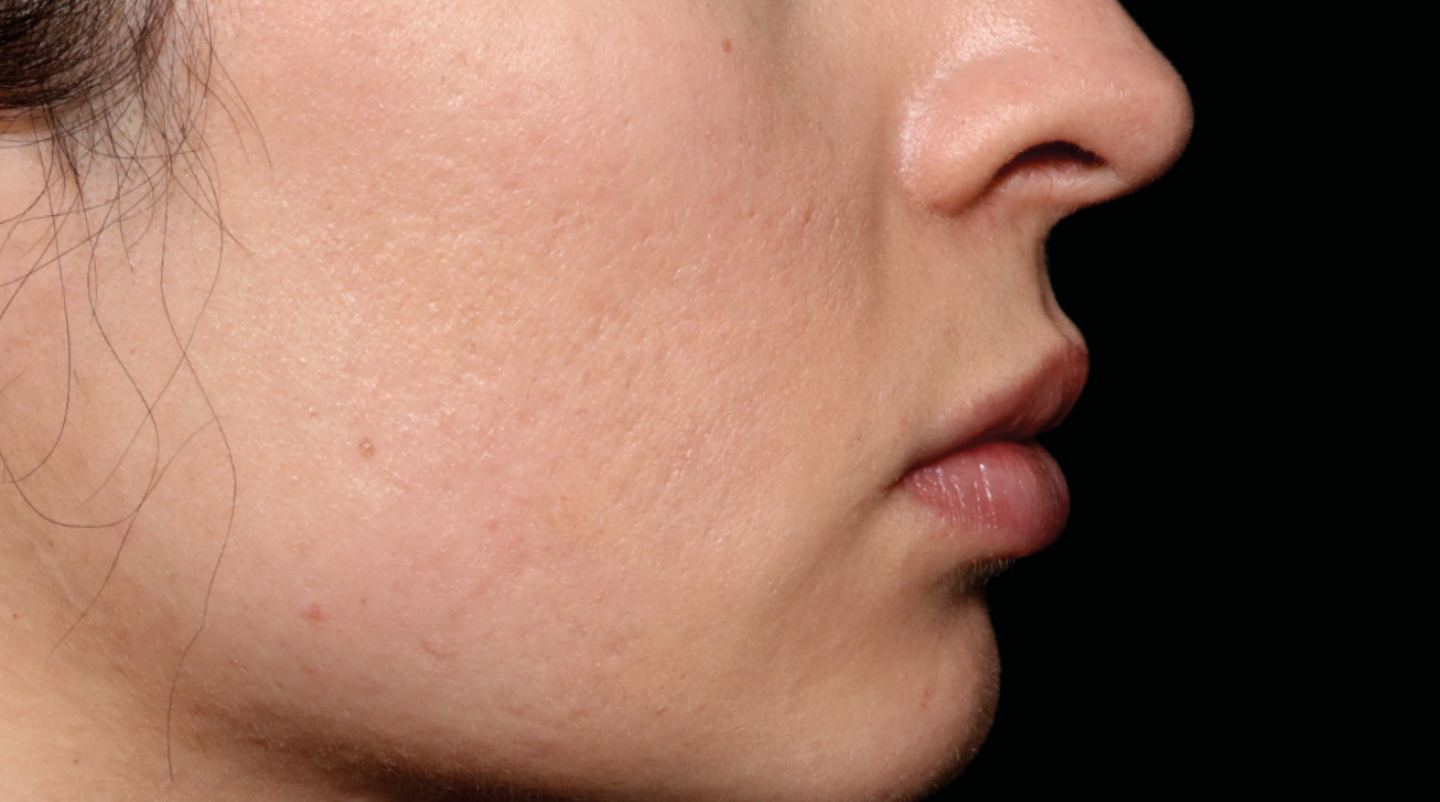 Radiofréquence Exion - Résultat cicatrice après traitement