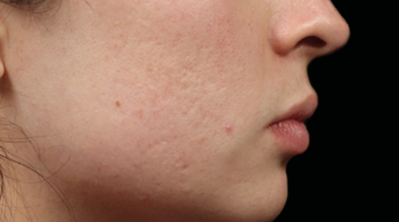 Radiofréquence Exion - Résultat cicatrice avant traitement