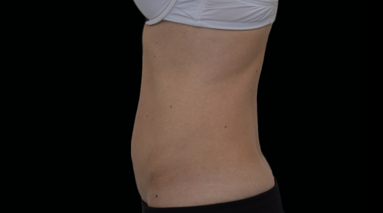Radiofréquence Exion - Résultat ventre après traitement