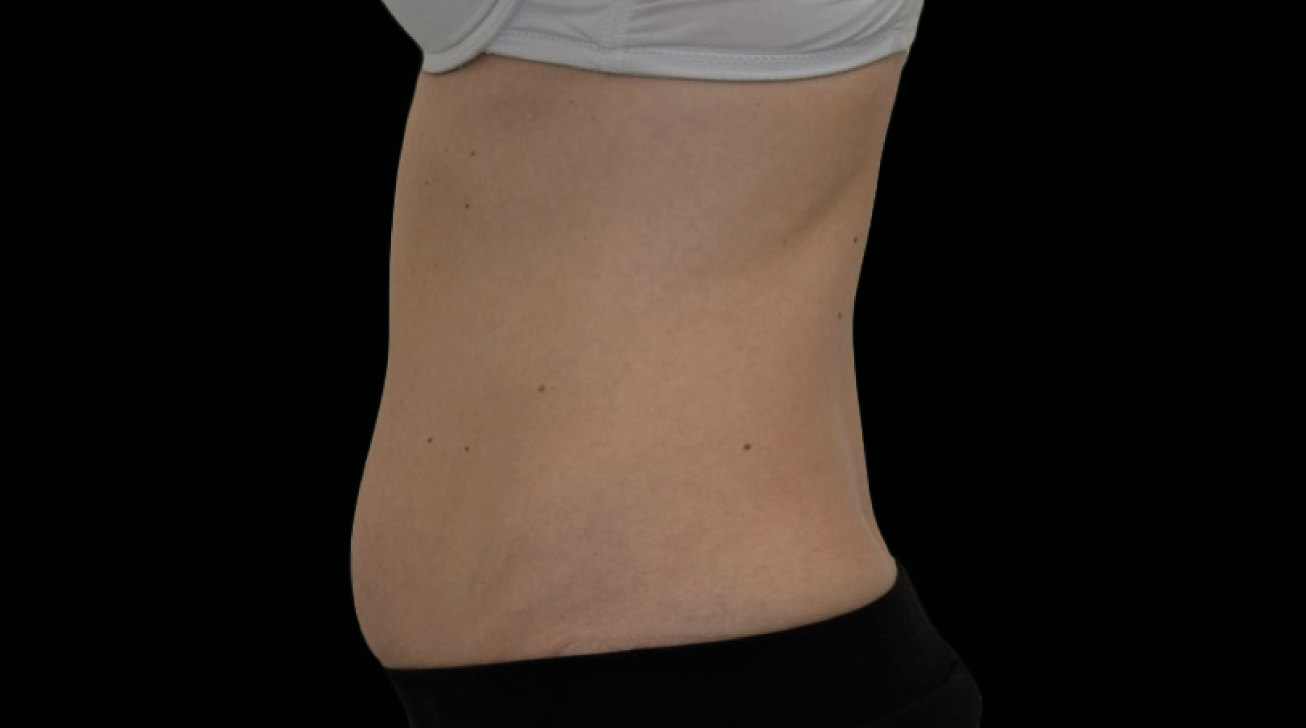 Radiofréquence Exion - Résultat ventre avant traitement