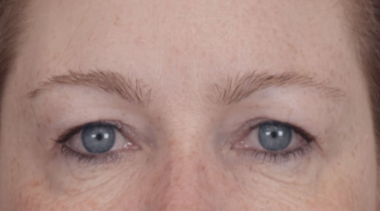 Radiofréquence Exion - Résultat yeux après traitement