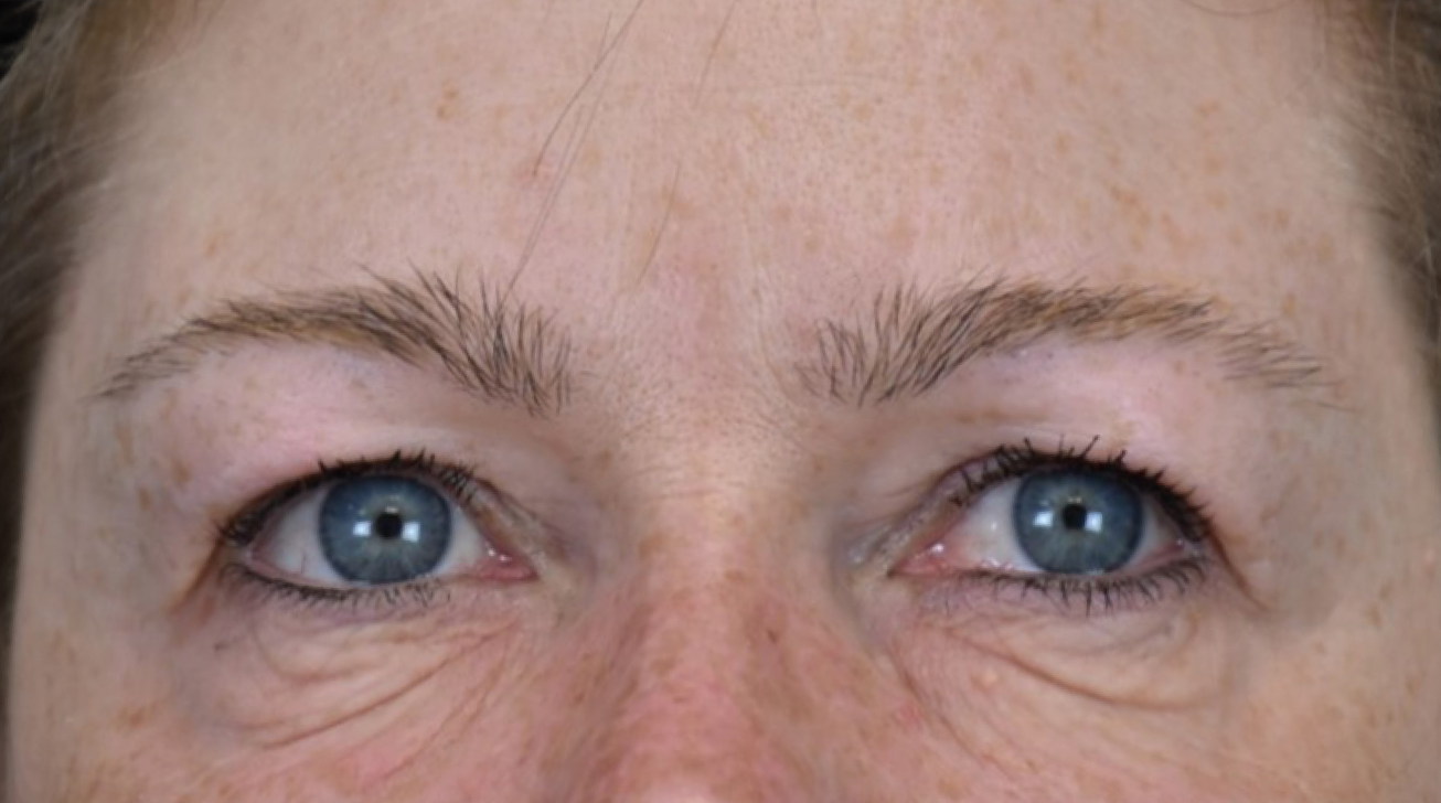 Radiofréquence Exion - Résultat yeux avant traitement