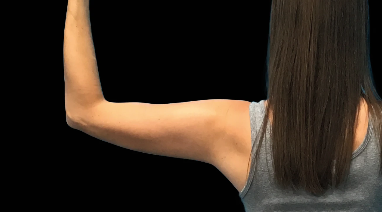 EmSculpt Neo Paris - Bras après traitement