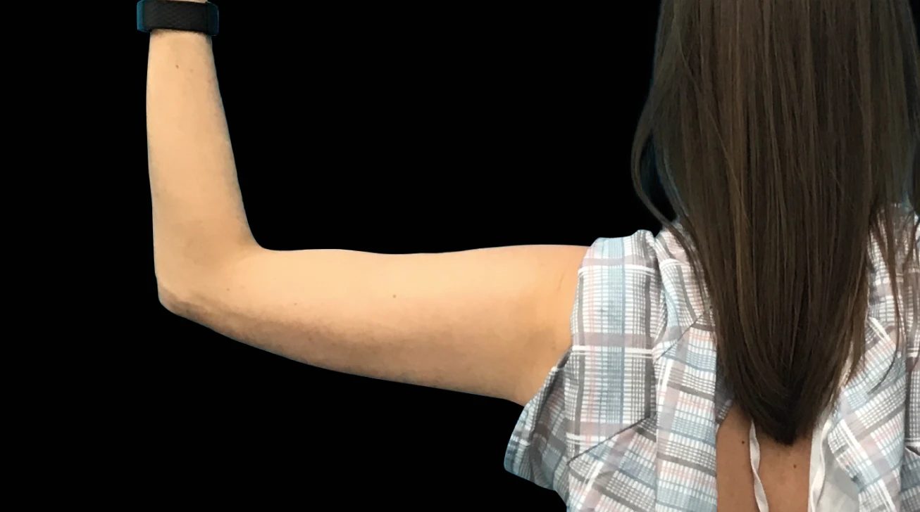 EmSculpt Neo Paris - Bras avant traitement