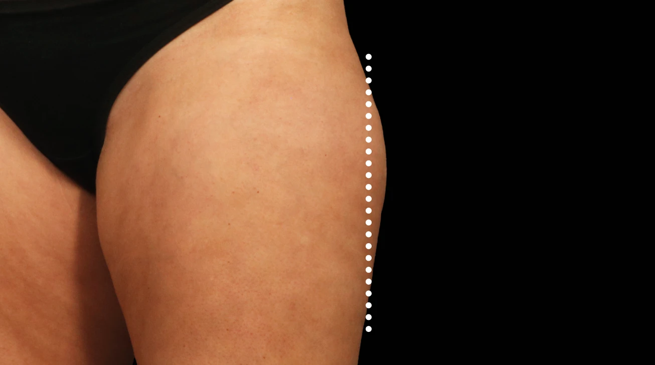 EmSculpt Neo Paris - cuisse avant traitement