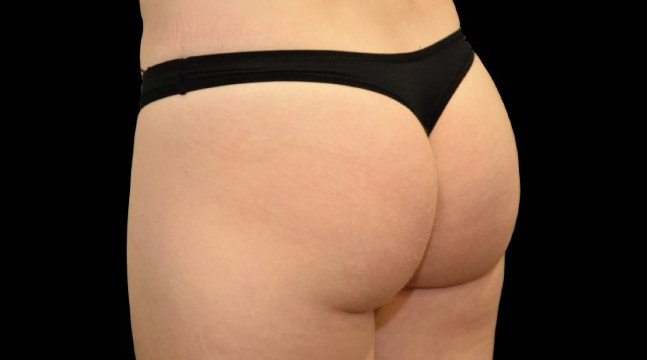 EmSculpt Neo Paris - fesses après traitement