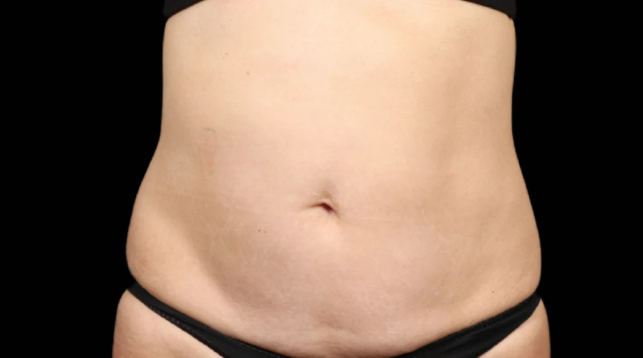 EmSculpt Neo Paris - ventre après traitement