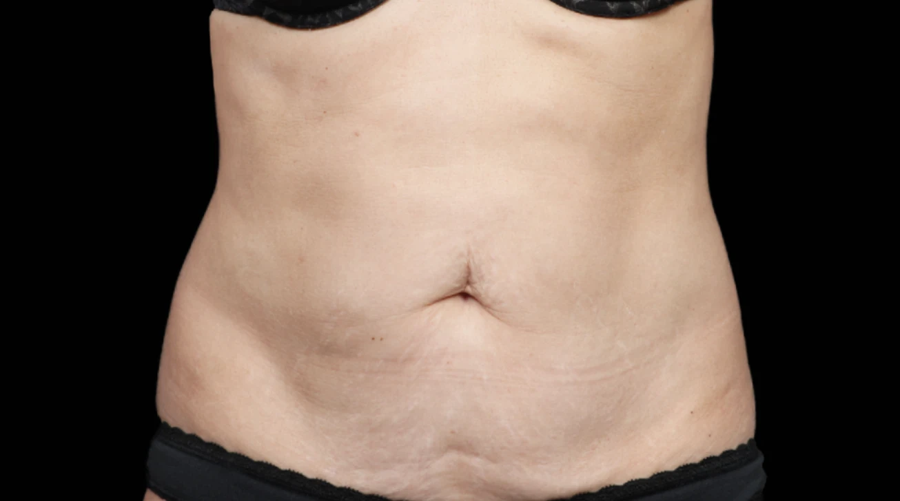 EmSculpt Neo Paris - ventre avant traitement