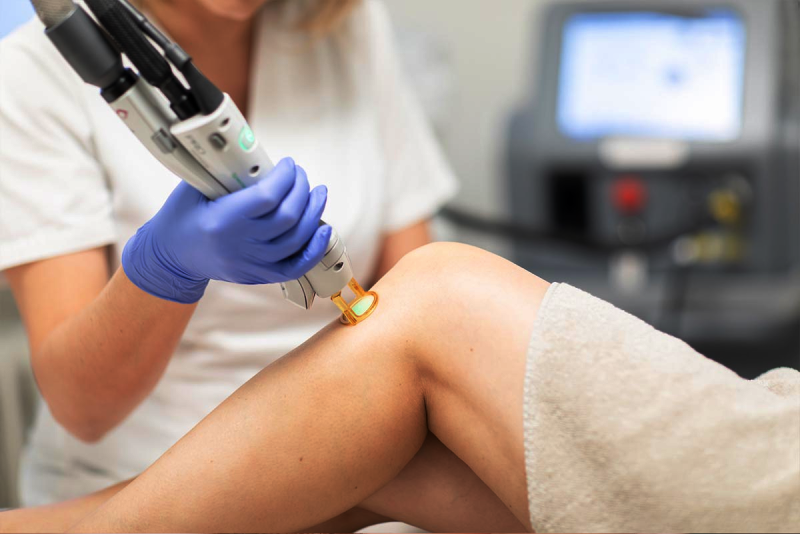 Epilation définitive Paris