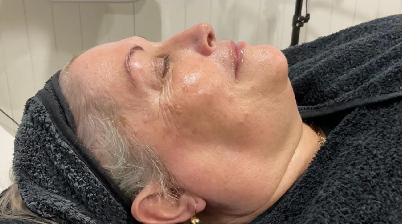 Traitement Geneo avant apres