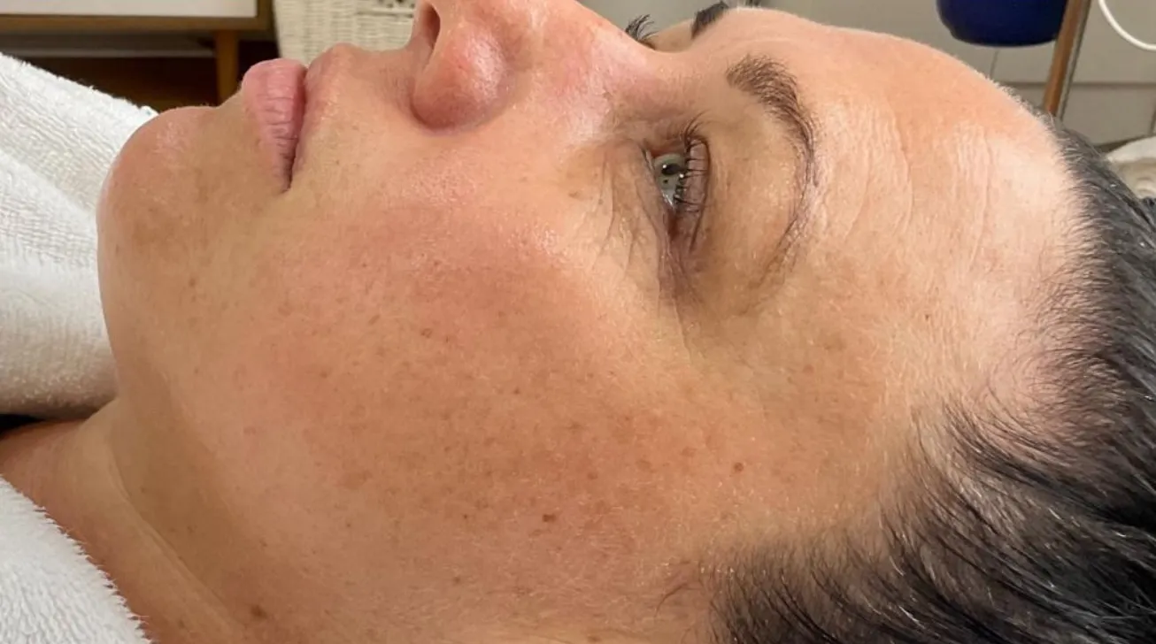 Traitement Geneo avant apres