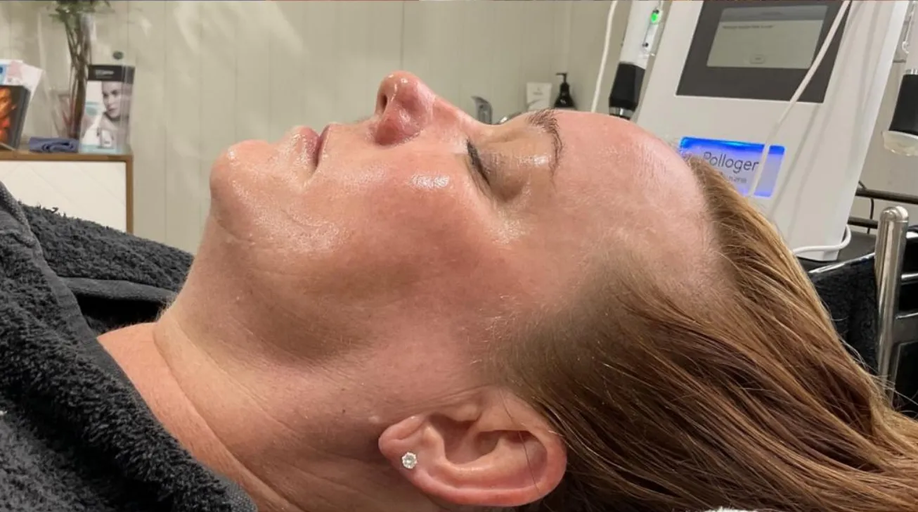 Traitement Geneo avant apres