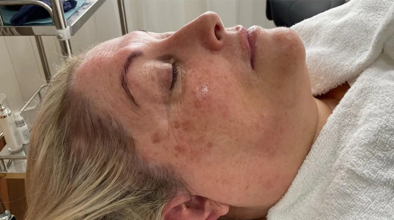 Traitement Geneo avant apres