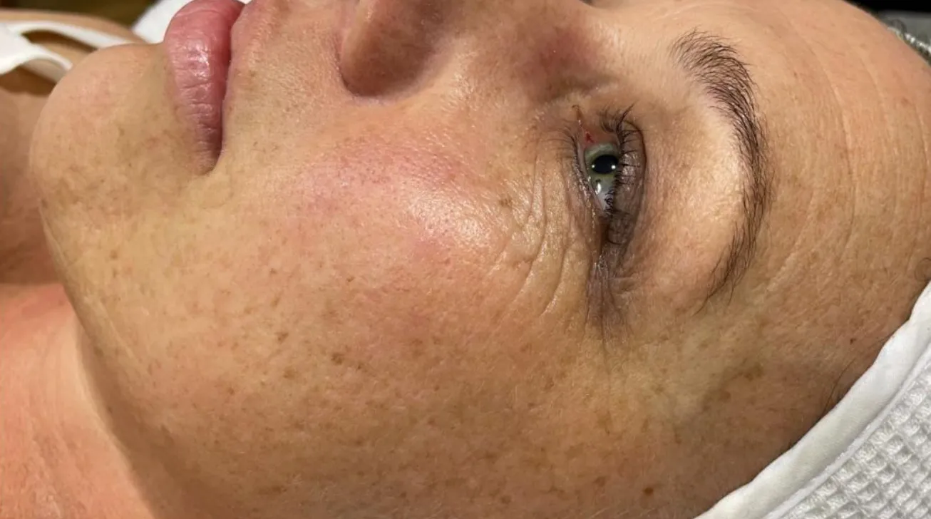 Traitement Geneo avant apres