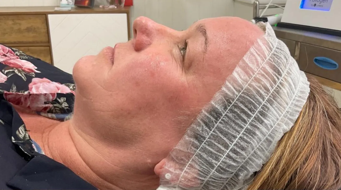 Traitement Geneo avant apres